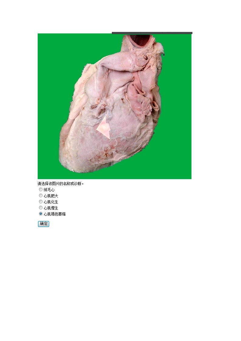 中国医科大学16年春《病理学(本科)》实践考试答案