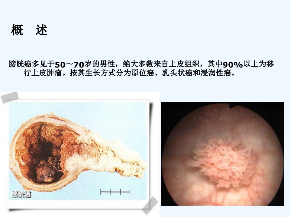 膀胱癌护理查房医学课件