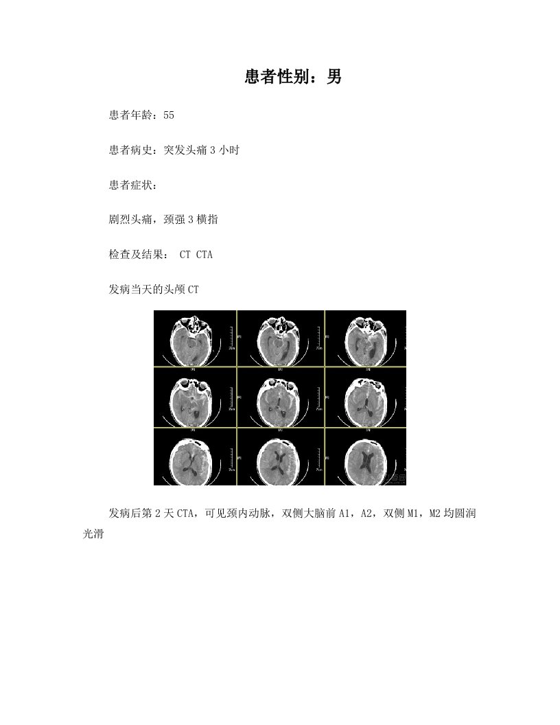 脑血管痉挛CVS