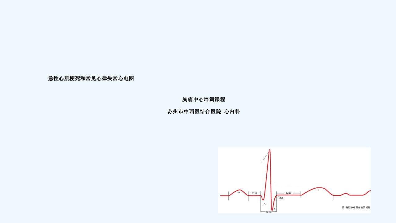 急性心肌梗死和常见心律失常心电图