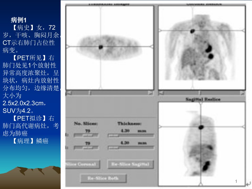 PET病例PPT课件