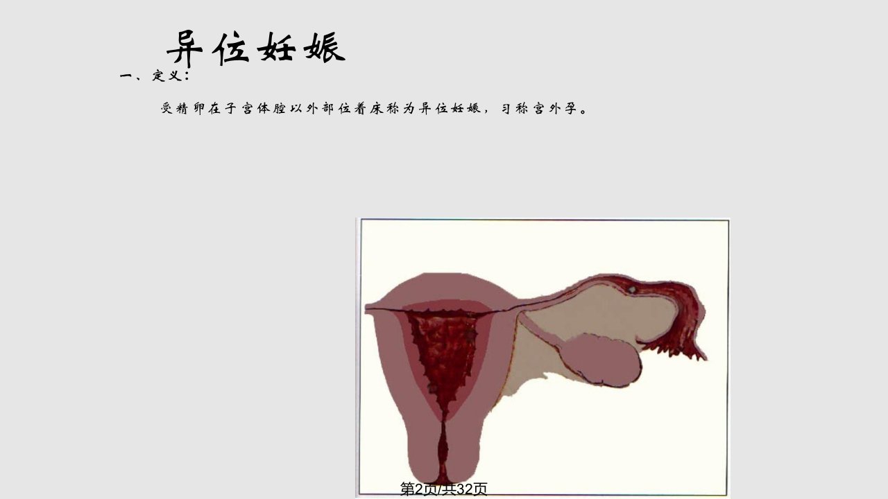 异位妊娠失血性休克的急救与护理