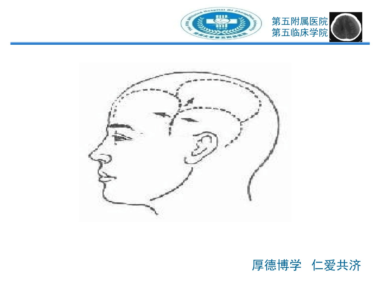 硬膜外血肿诊疗ppt课件