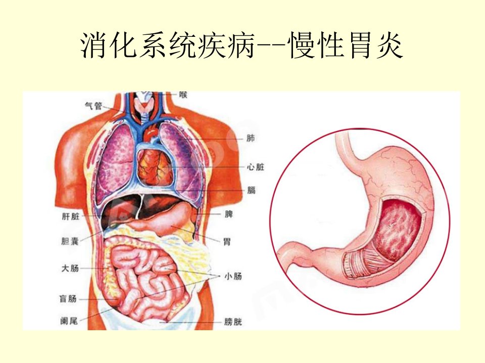 消化系统疾病--慢性胃炎