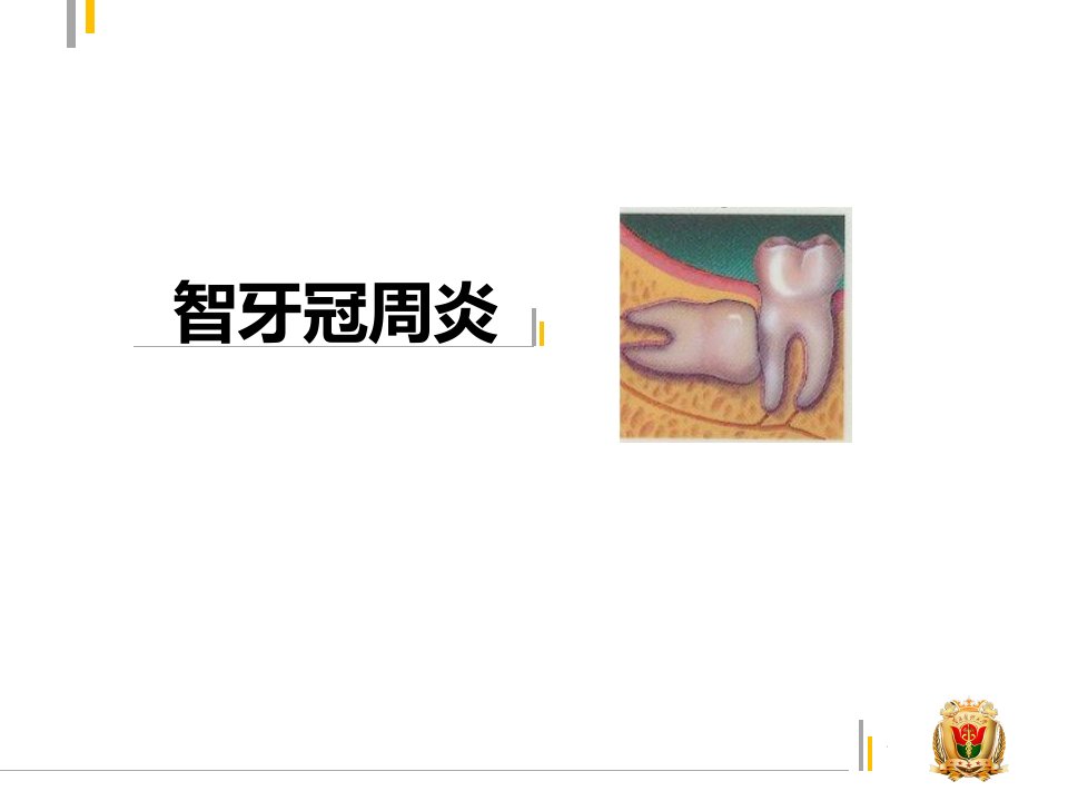 智牙冠周炎ppt课件