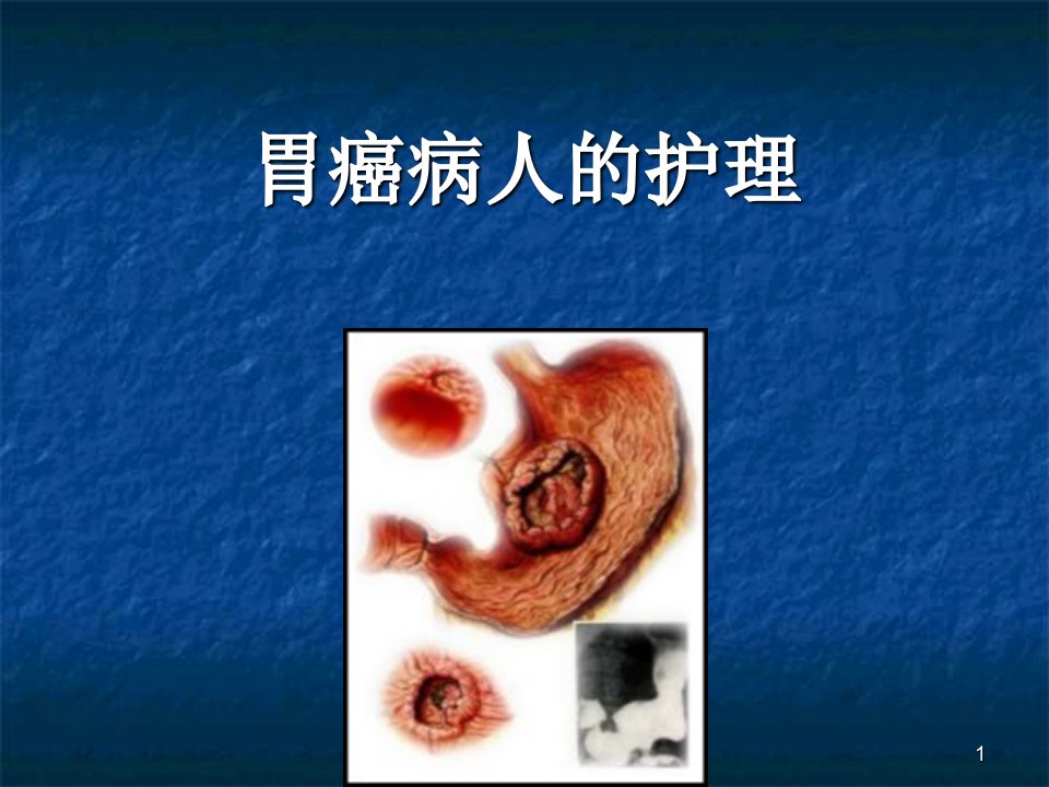 内科护理学胃癌护理PPT课件