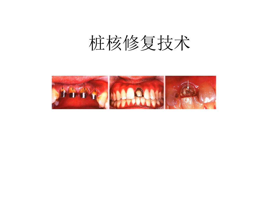 口腔修复科桩核修复技术