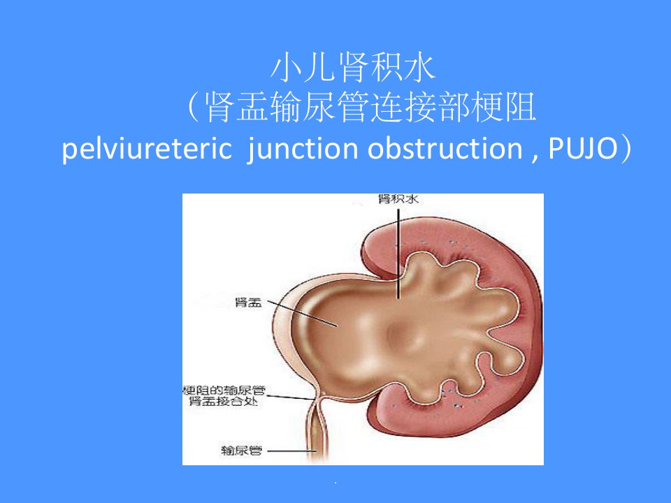 小儿肾积水ppt课件