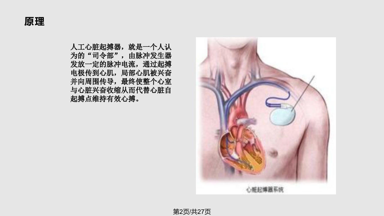 起搏器植入术的健康教育