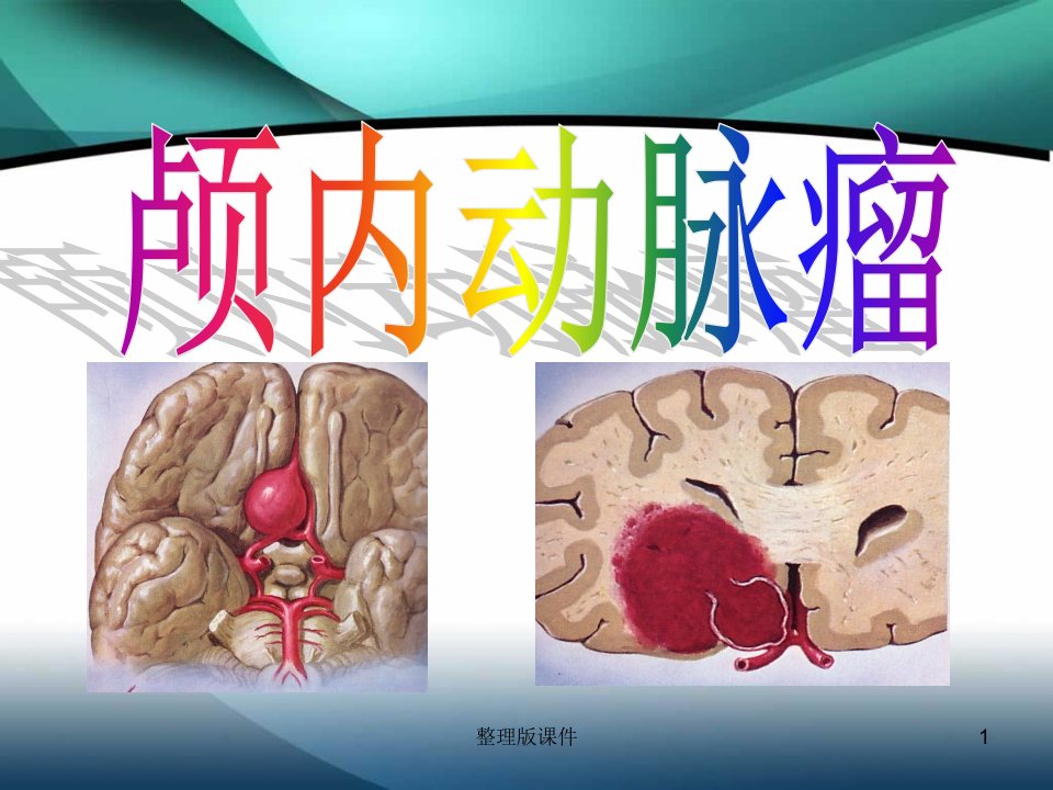 颅内动脉瘤介入术后的护理ppt课件