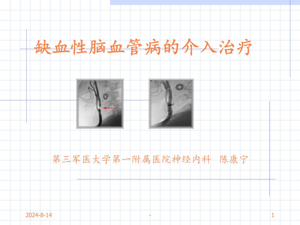 缺血性脑血管病的介入治疗ppt课件