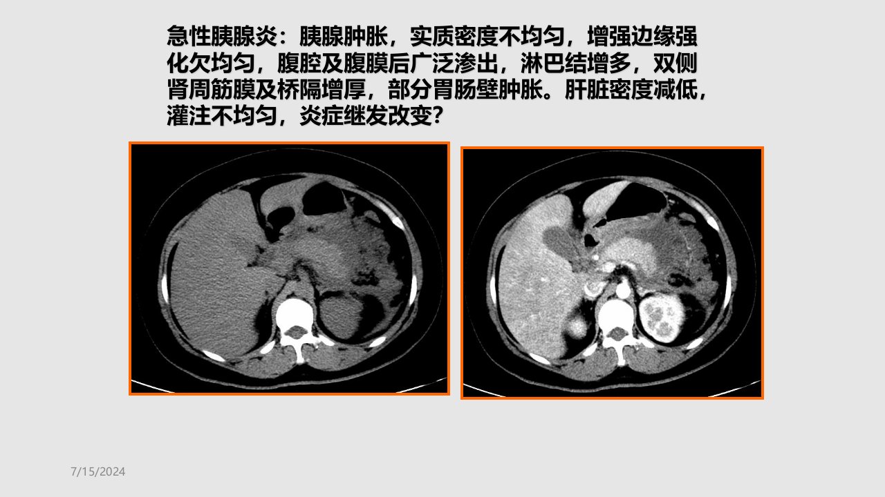 急性胰腺炎液体复苏