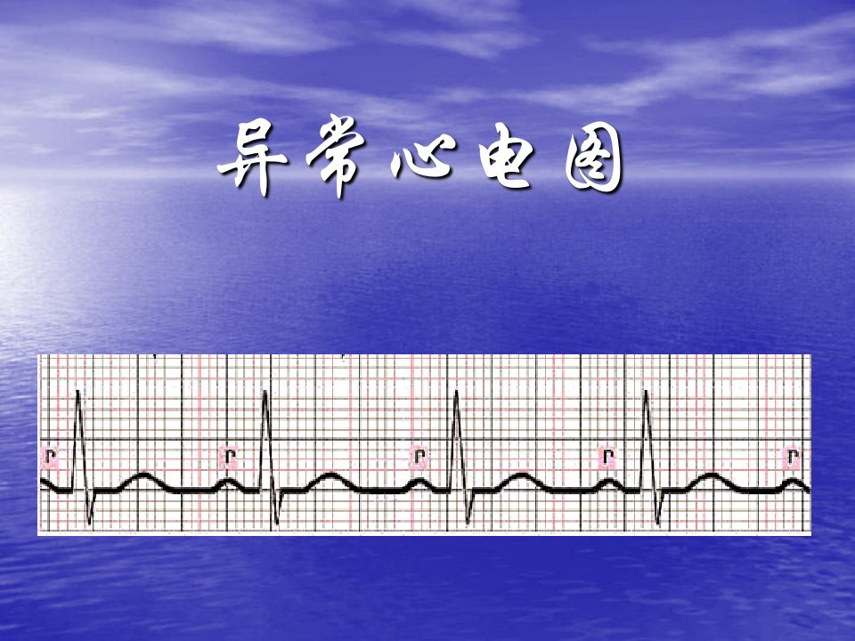 《异常心电》PPT课件