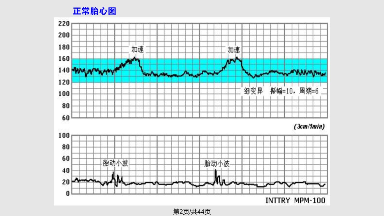 胎心监护详解