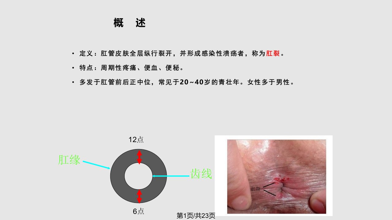 肛裂教学PPT课件