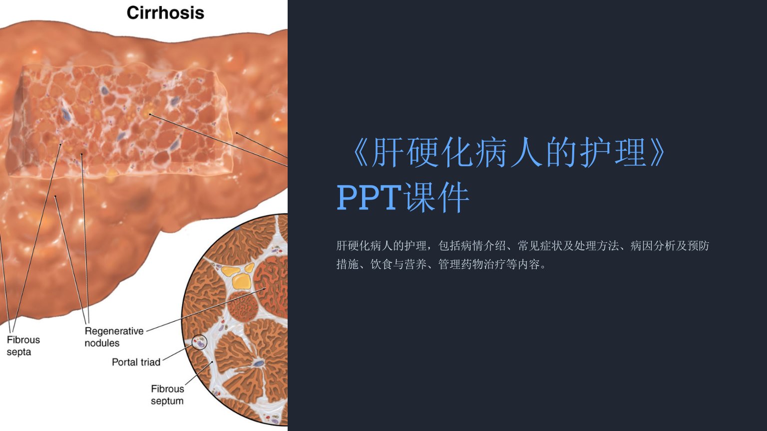 《肝硬化病人的护理》课件