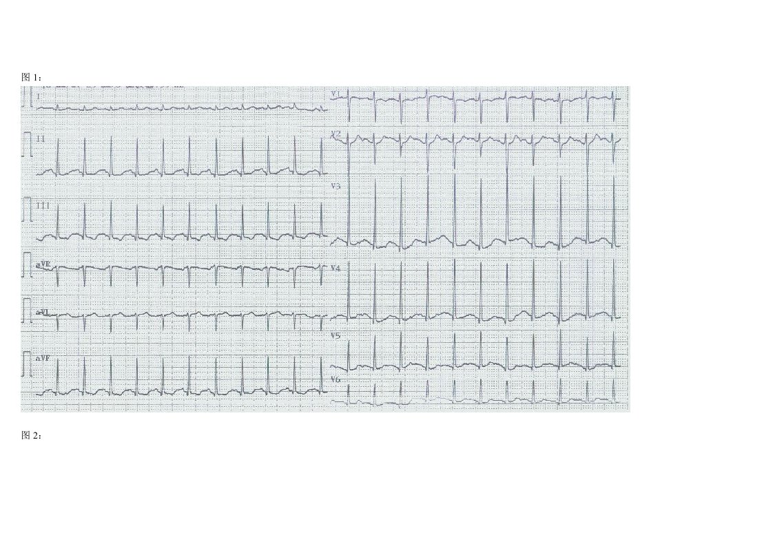 心电图阅图试题14题及答案