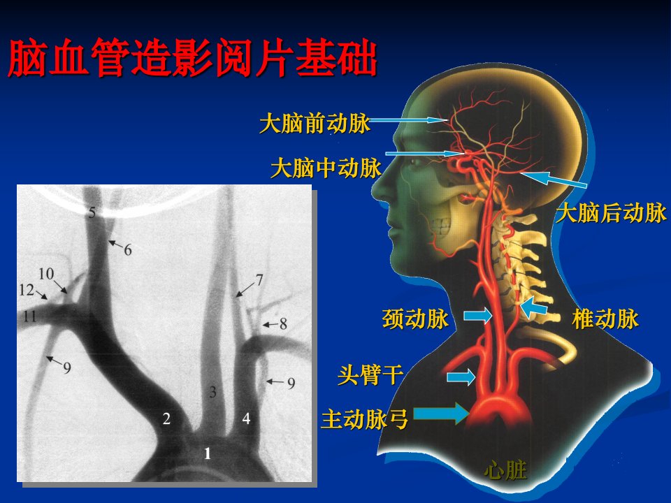 脑血管造影阅片