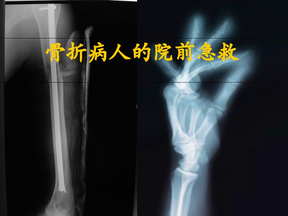 骨折病人的院前急救