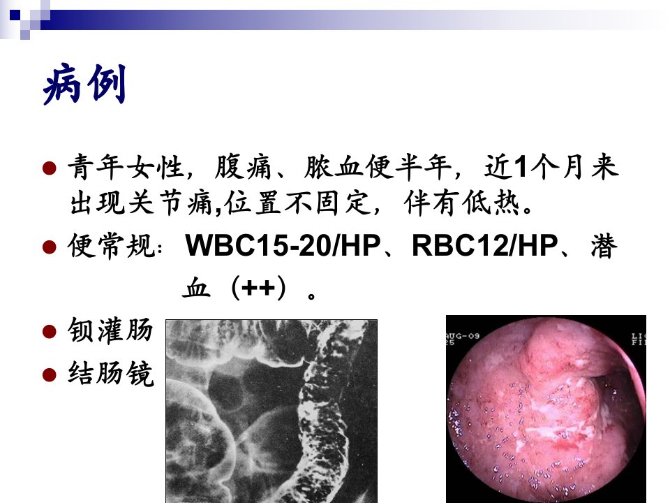 炎症性肠病.ppt7年制