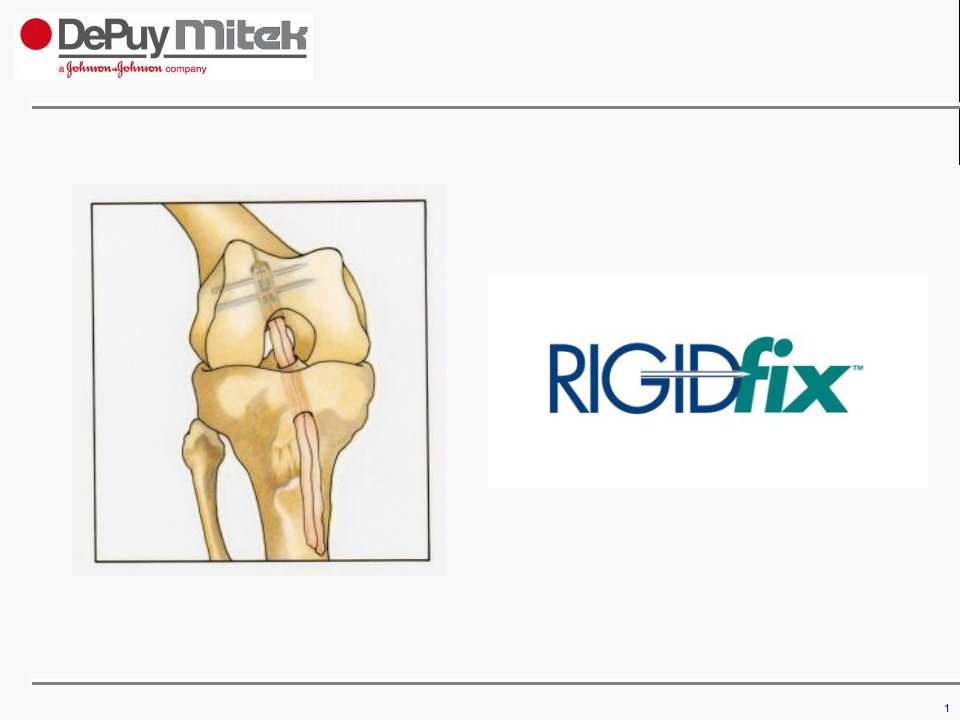 RigidfixSTBTB股骨端交叉钉