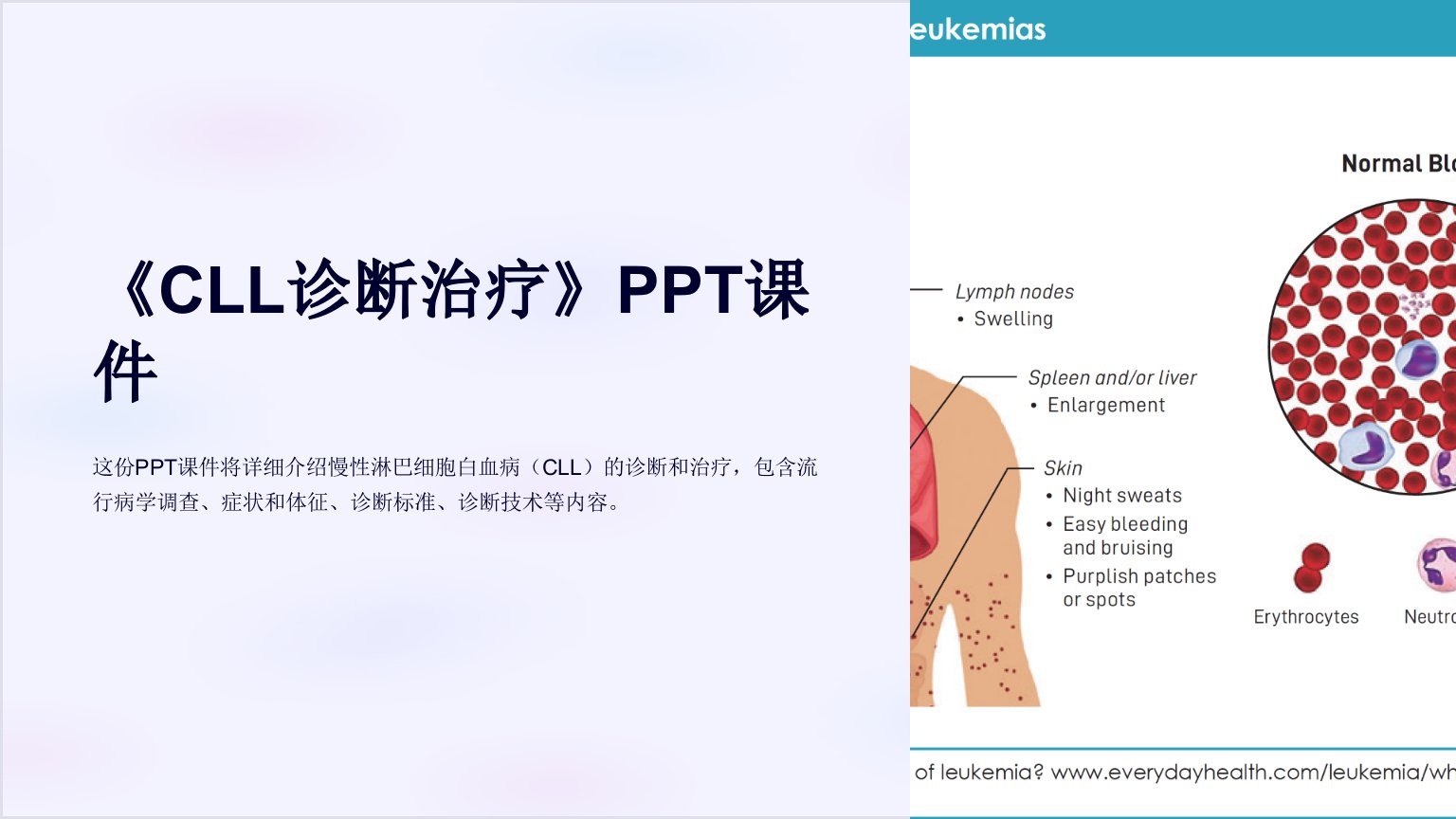 《CLL诊断治疗》课件