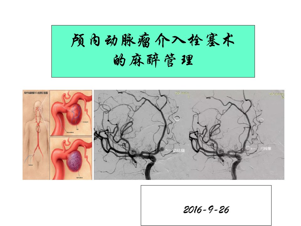 颅内动脉瘤介入栓塞术的麻醉管理