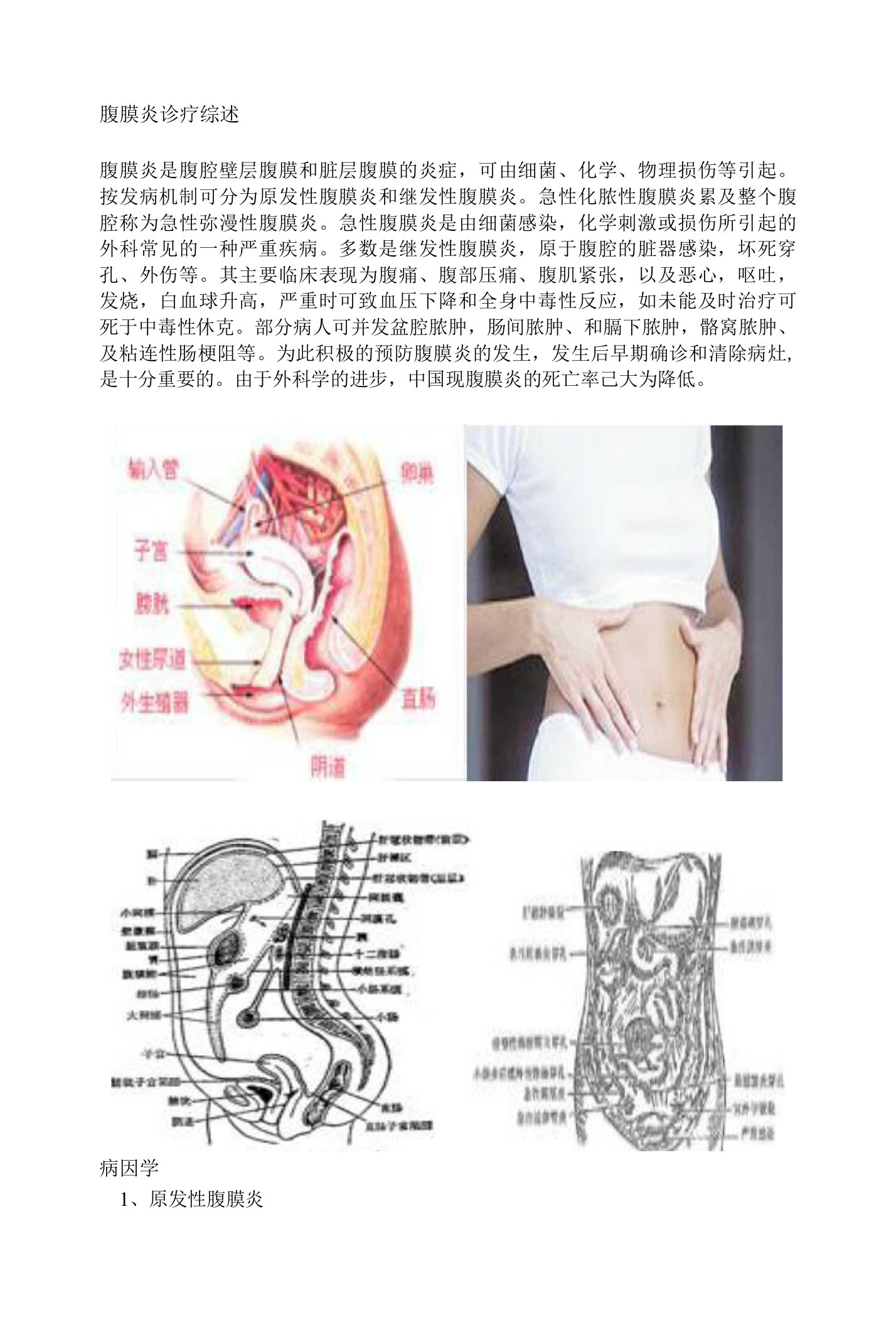 【精品】腹膜炎诊疗综述