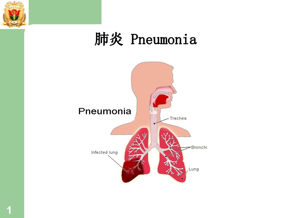 儿科肺炎