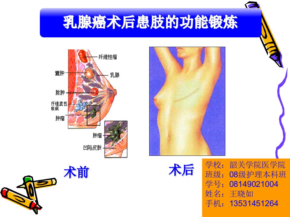 乳腺癌术后的功能锻炼.ppt