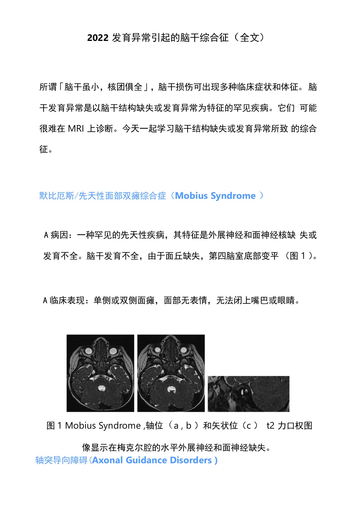 2022发育异常引起的脑干综合征（全文）