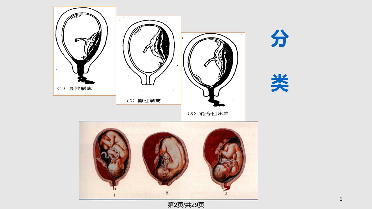 胎盘早剥学习