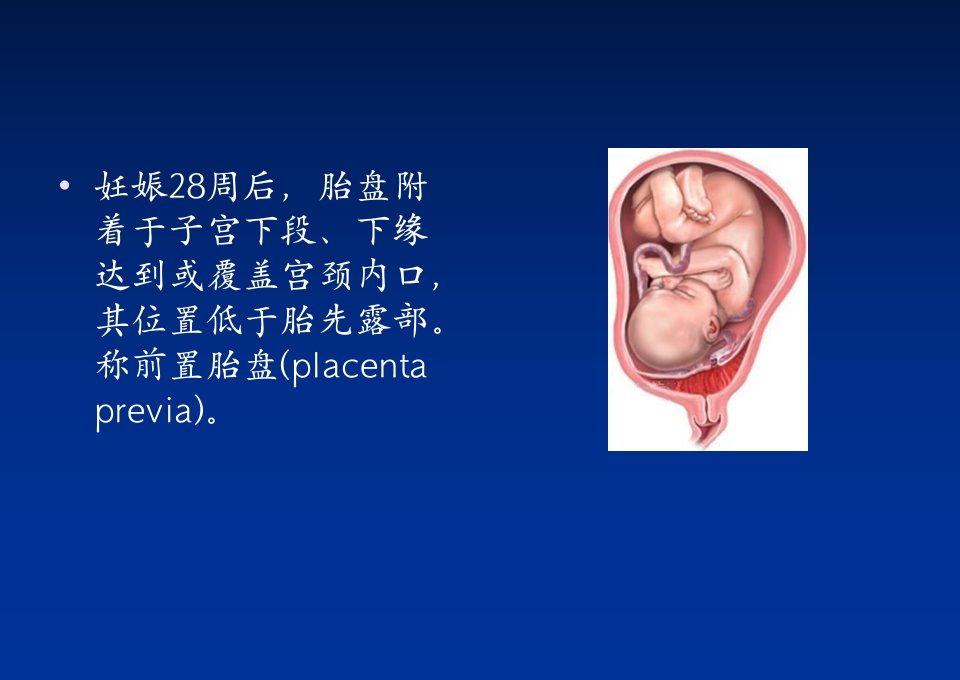 前置胎盘教学查房宣讲-PPT医学课件