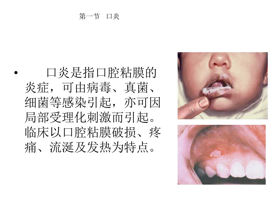 口炎患儿的护理