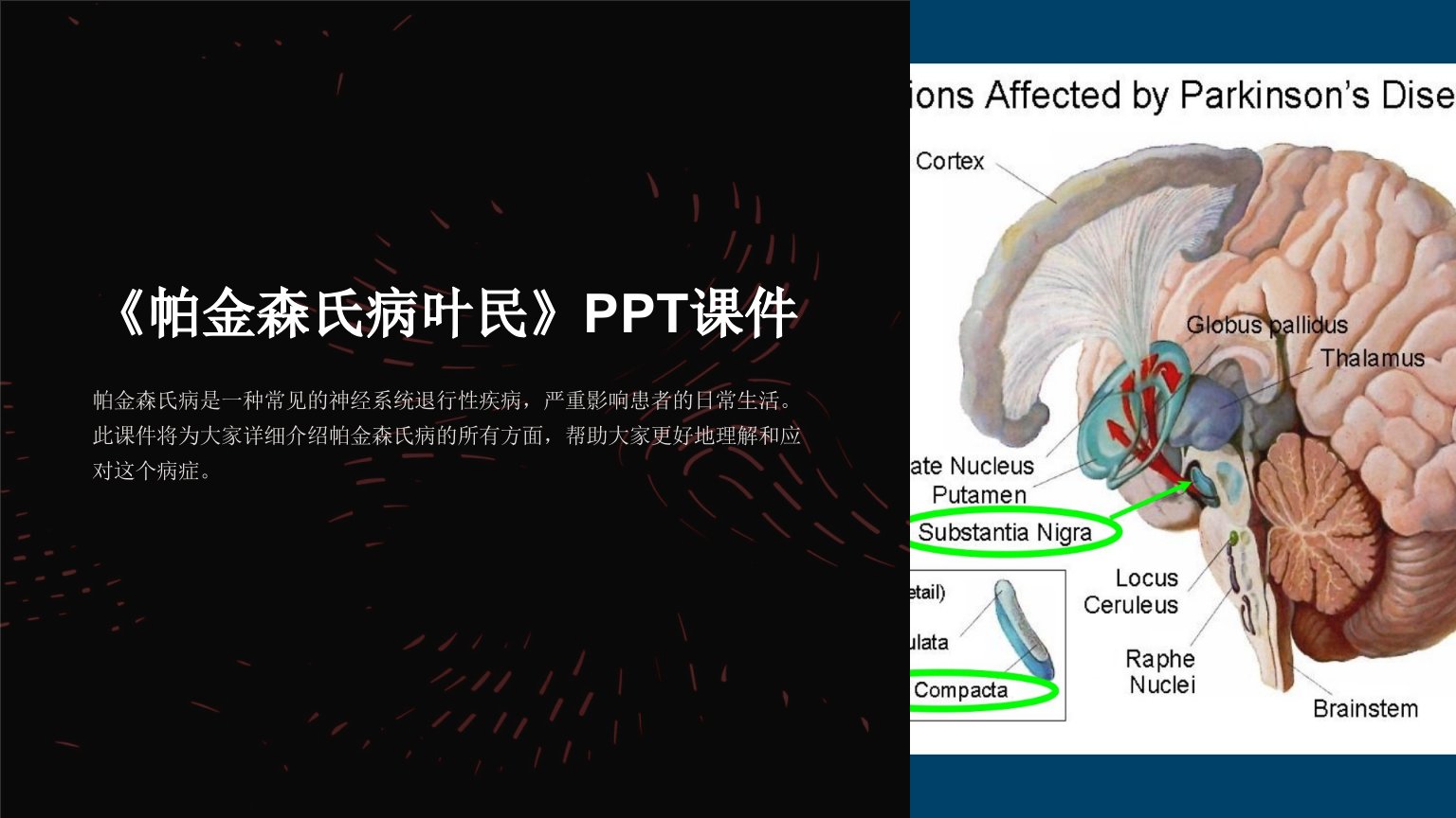 《帕金森氏病叶民》课件