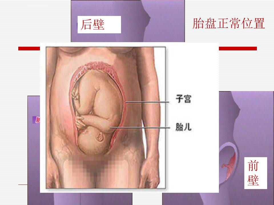 前置胎盘护理ppt课件