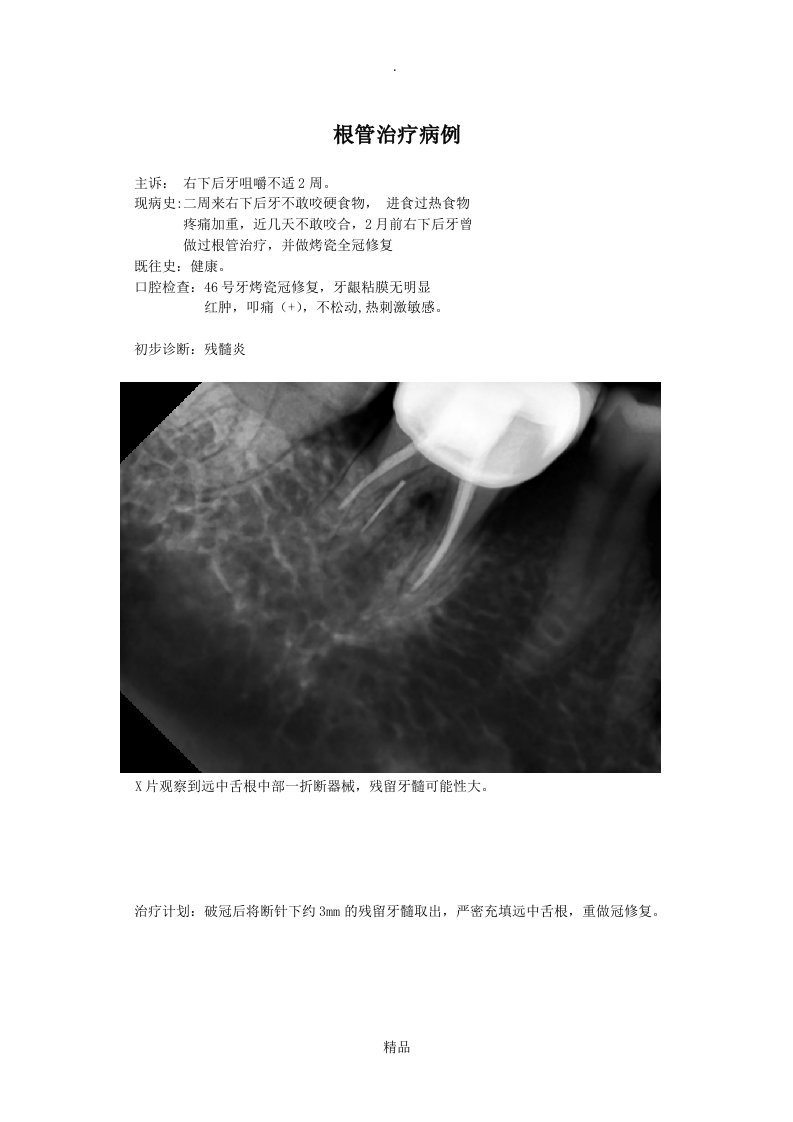 根管治疗病例