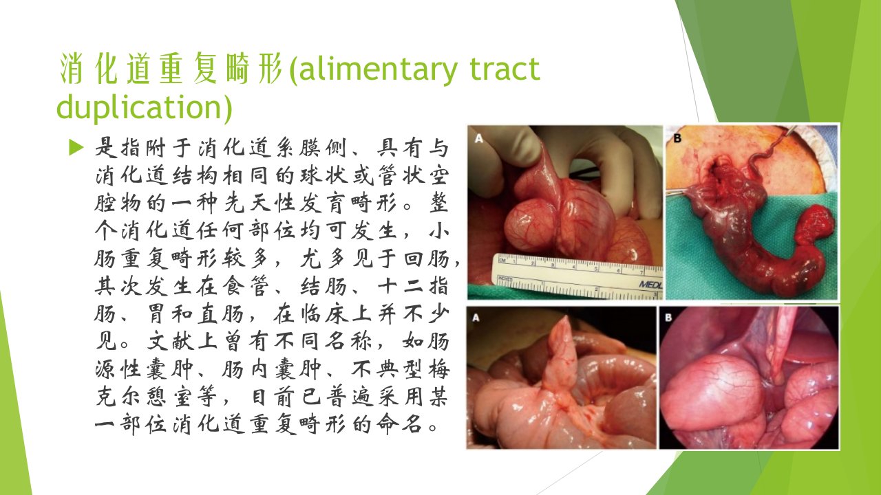 消化道重复畸形972003