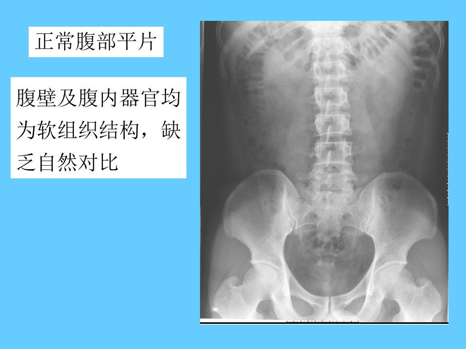 肠梗阻x线表现