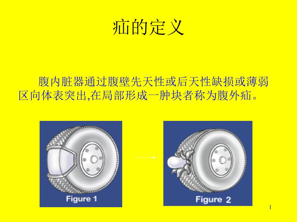 腹外疝高中其它科目课件教案人教版