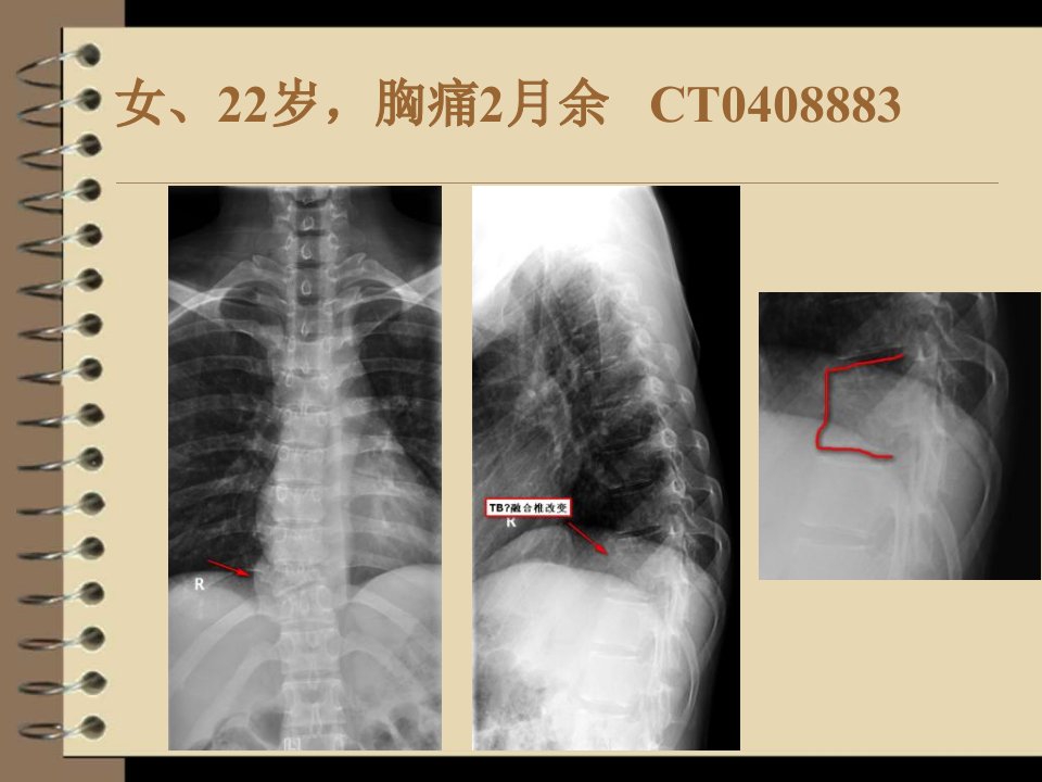 脊柱原发性恶性淋巴瘤的影像诊断