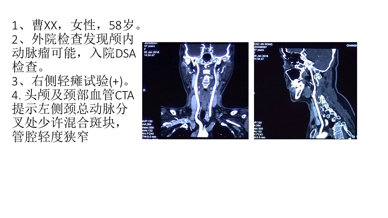 颈动脉狭窄的治疗选择cas还是cea