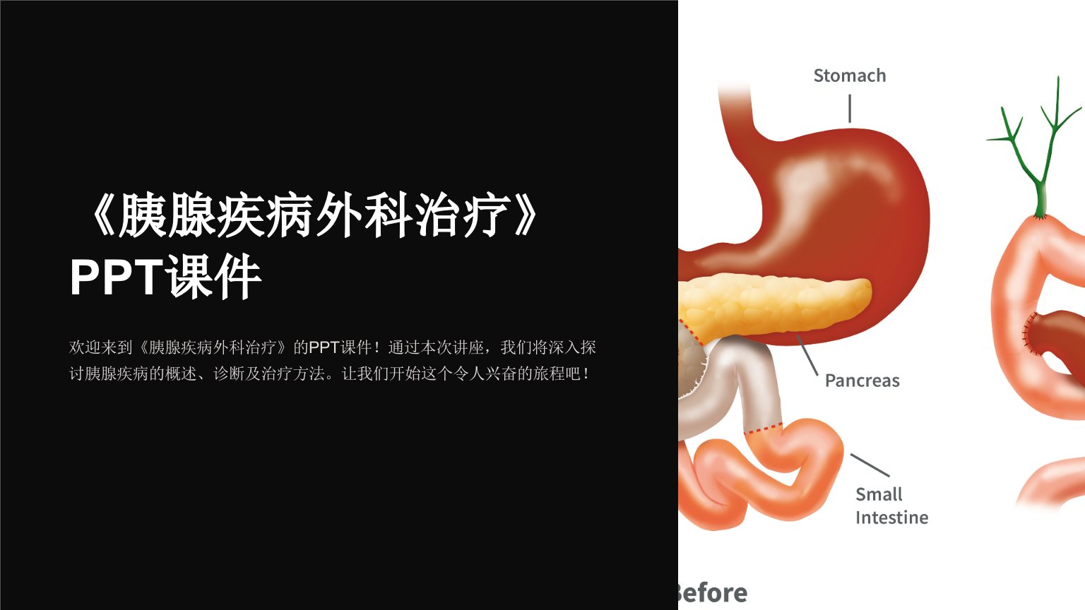 《胰腺疾病外科治疗》课件