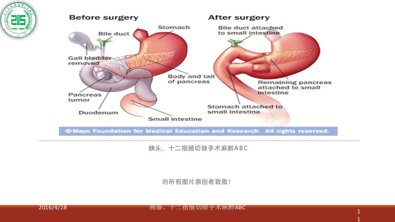 胰腺、十二指肠手术麻醉