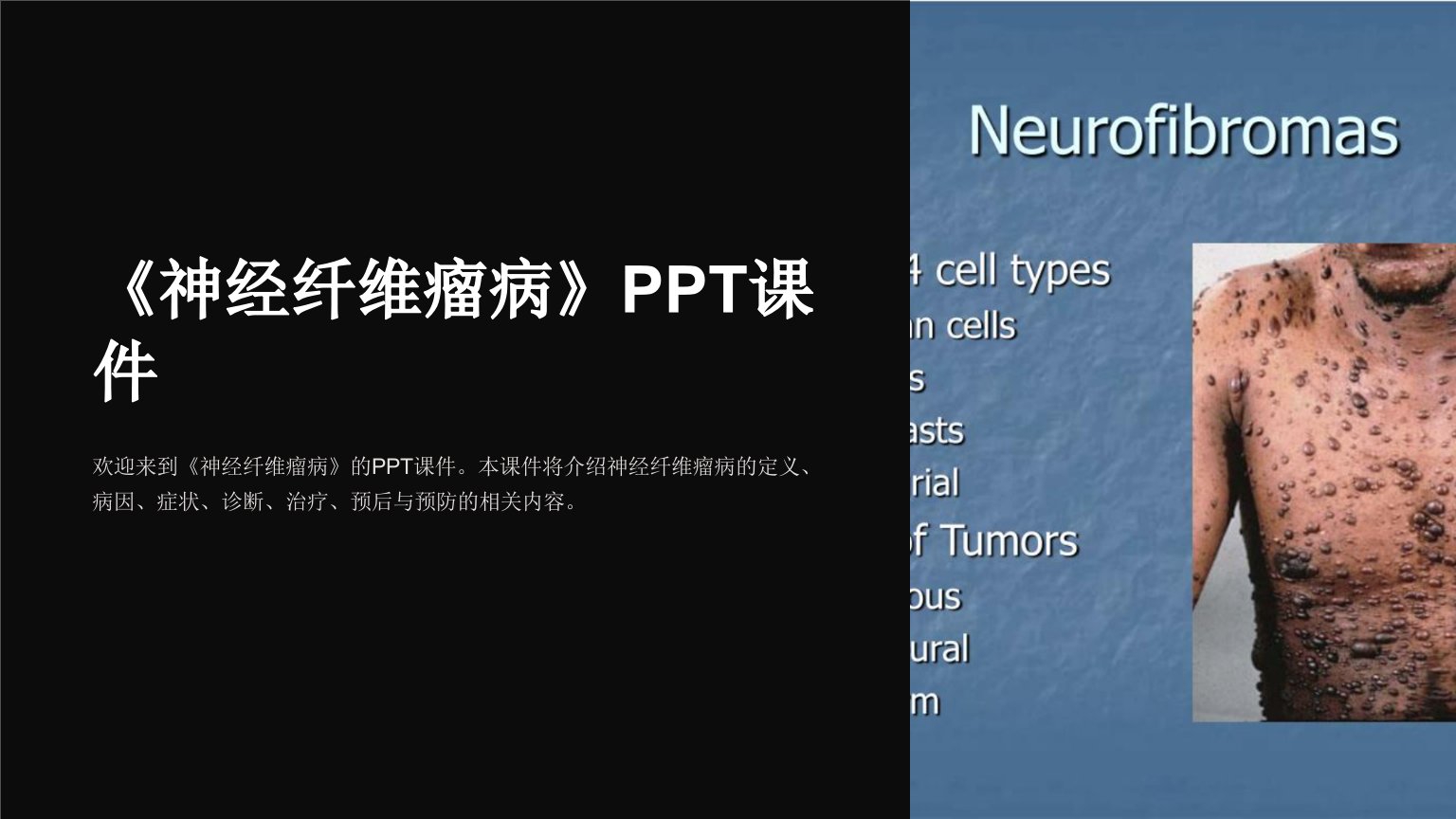 《神经纤维瘤病》课件