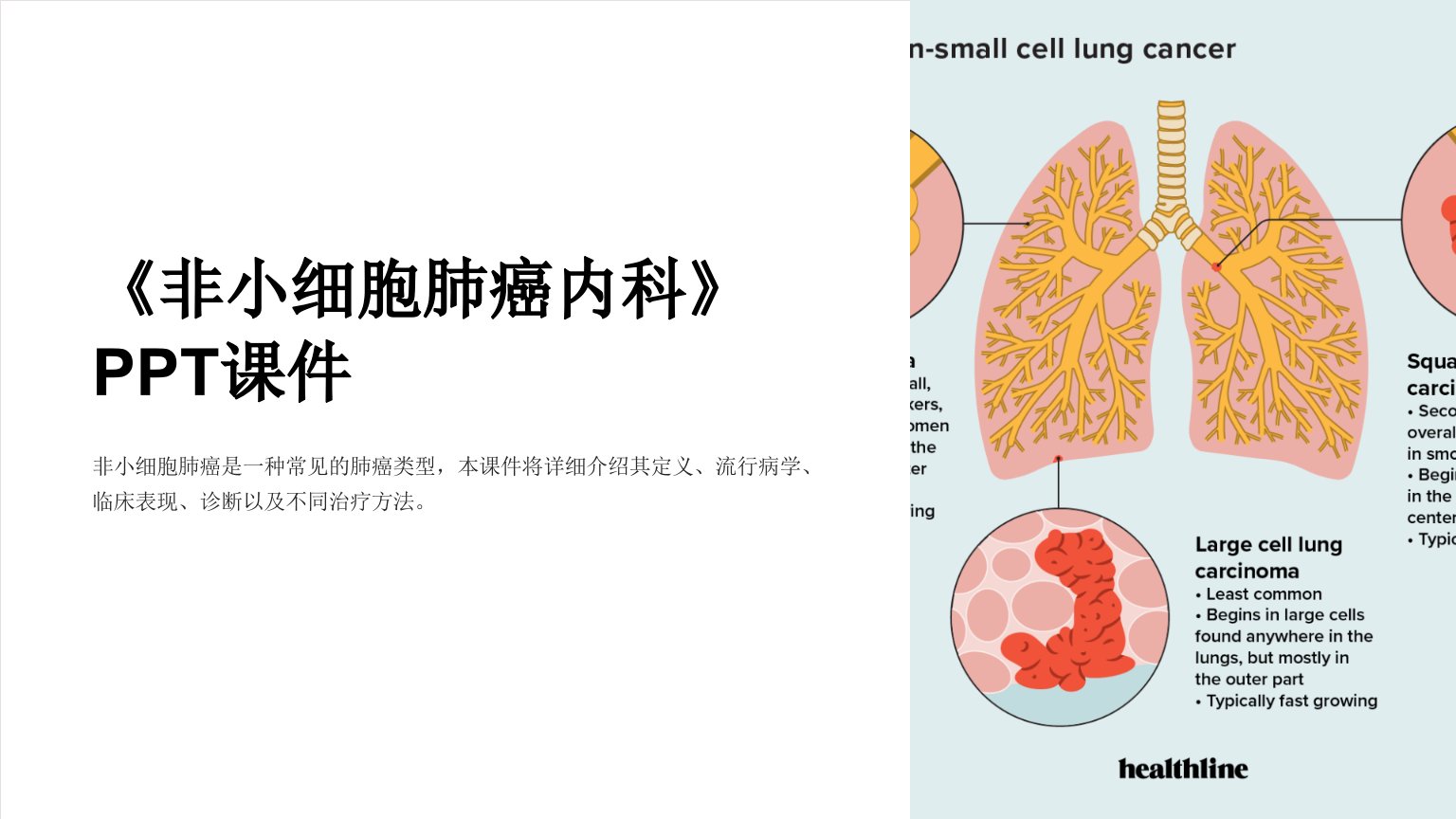 《非小细胞肺癌内科》课件