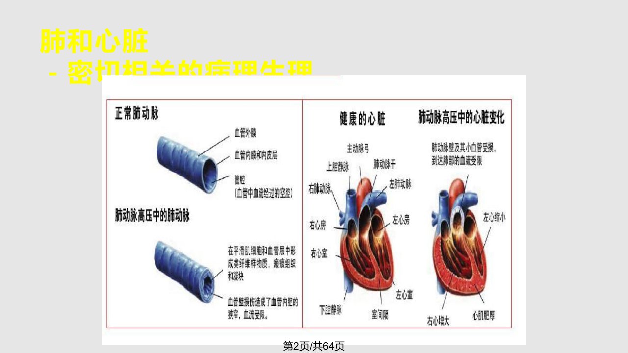 肺动脉高压与慢性肺源性心脏病