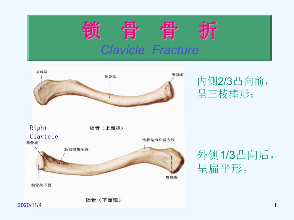 锁骨骨折片