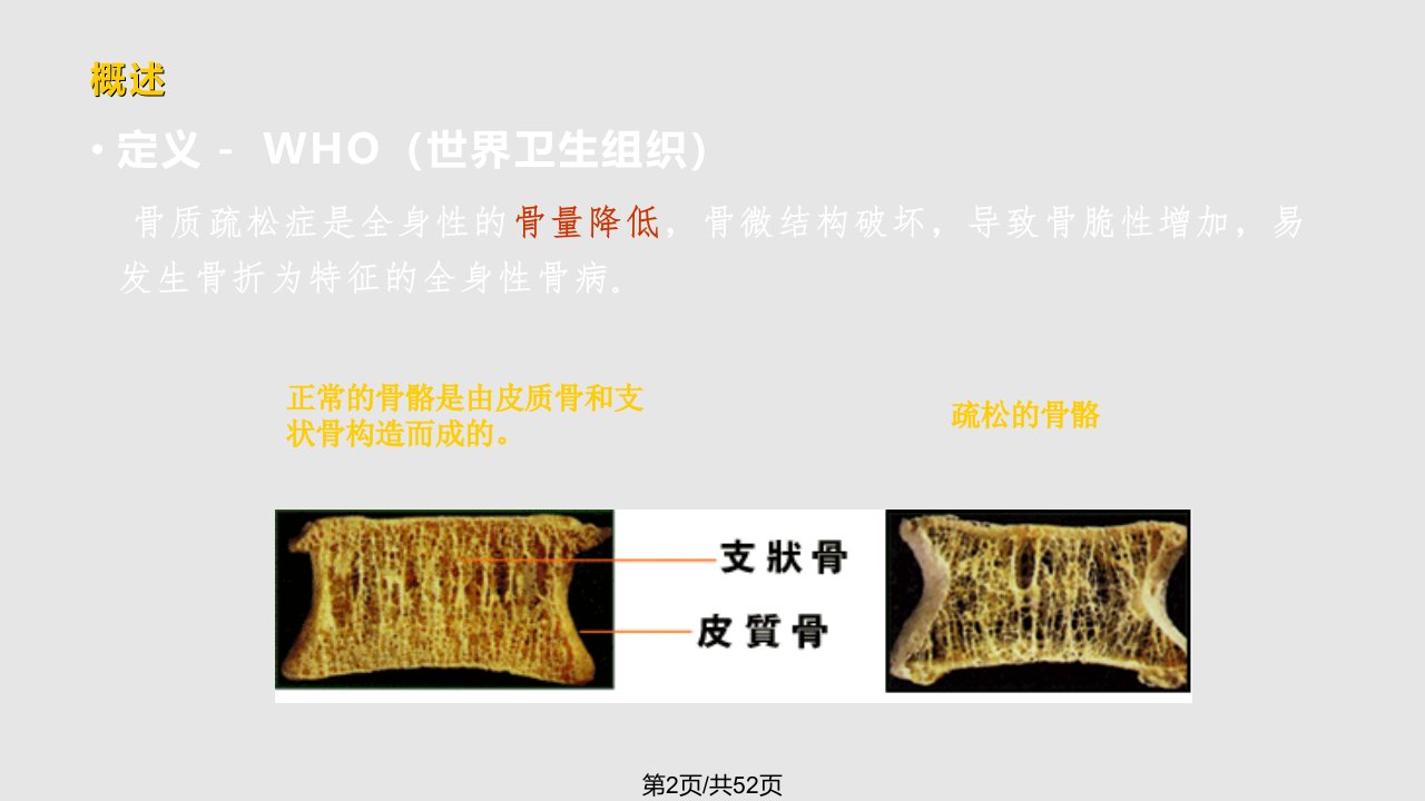 中国骨质疏松诊治指南新