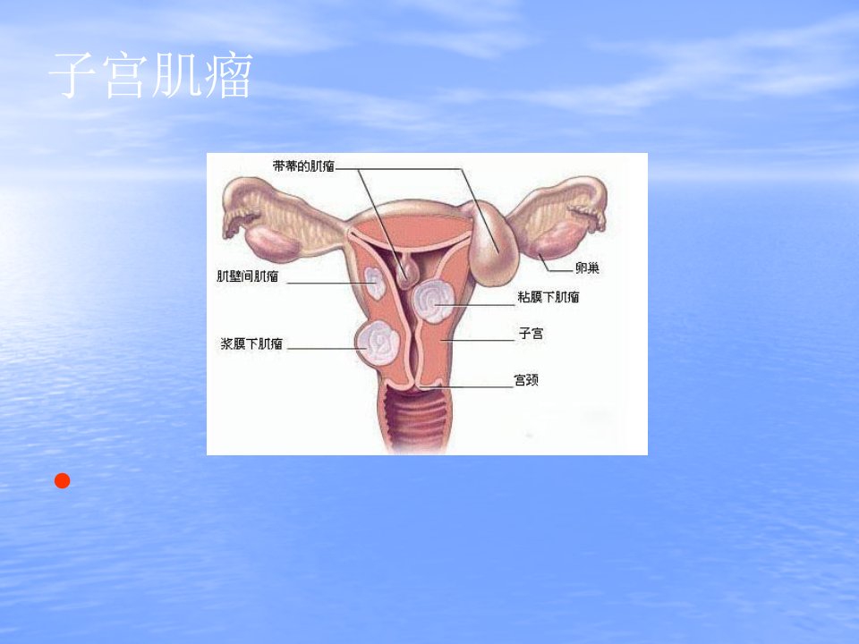 子宫肌瘤课件-课件(PPT演示)